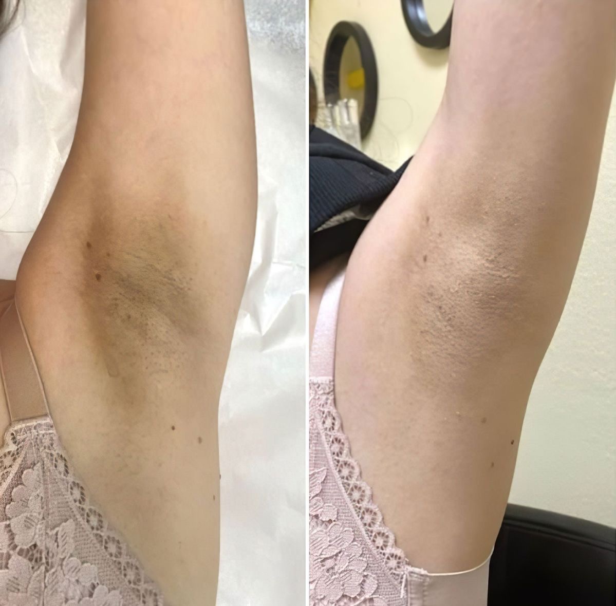 نتیجه اسپری پیل شات دکتر ملاکسین
