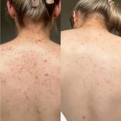 نتیجه استفاده پیل شات دکتر ملاکسین