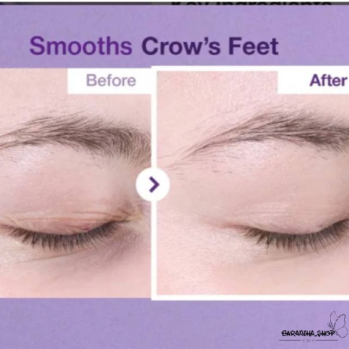 ناثیر استفاده از کرم دور چشم + NAD و رتینول نامبوزین ناثیر استفاده از کرم دور چشم + NAD و رتینول نامبوزین